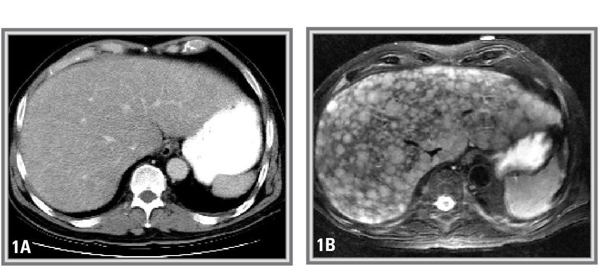 Liver Cancer CT vs MRI