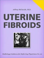 Uterine Fibroids by Jeffrey McTavish, MD