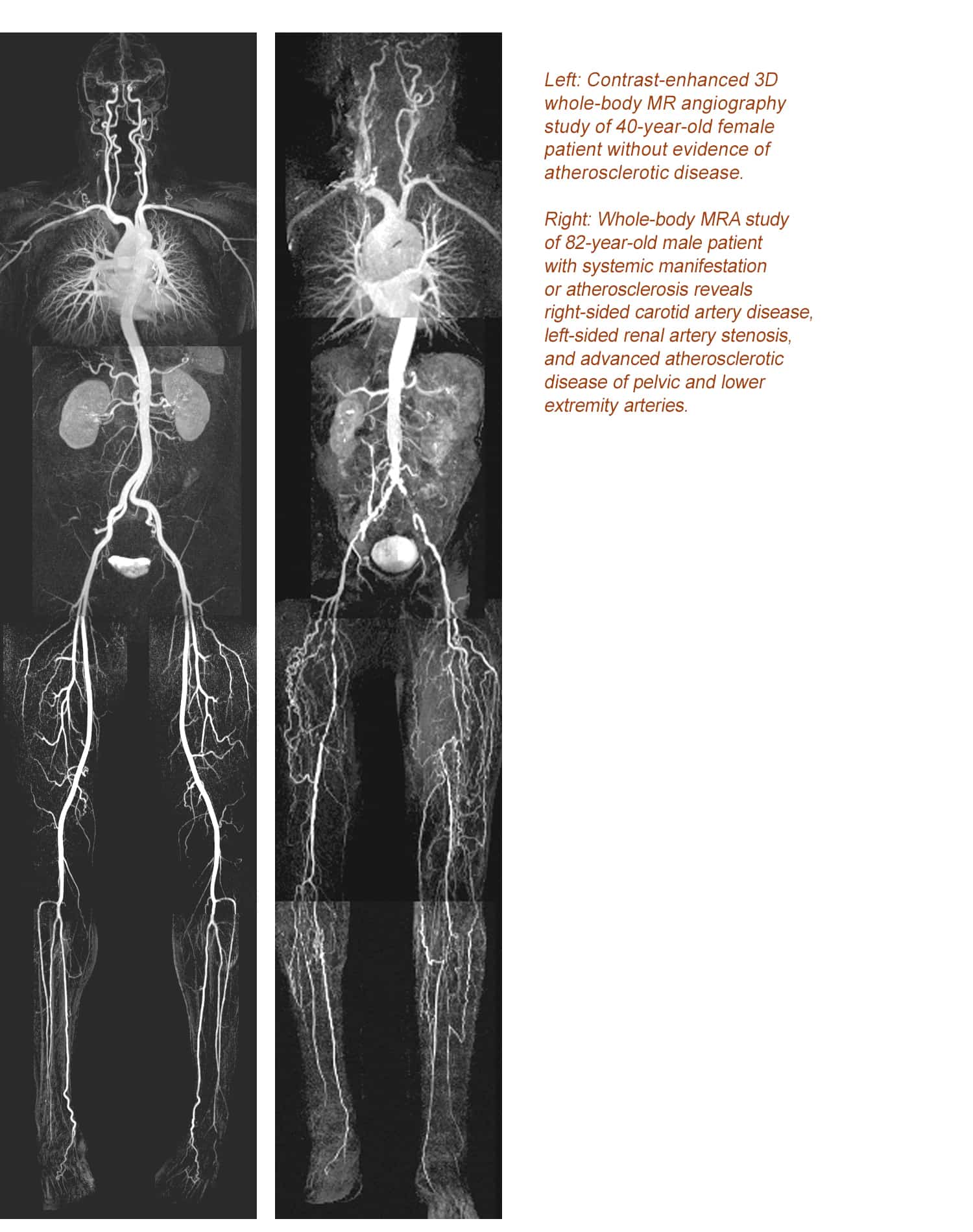 Full Body Magnetic Resonance Angiography